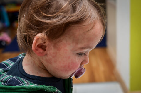 Children viral disease or allergies. Red measles rash on baby. Child with viral children disease infection. Concept of viral baby disease and vaccination.